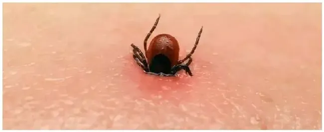 蜱虫怎么治疗用什么药 | 科普知识
